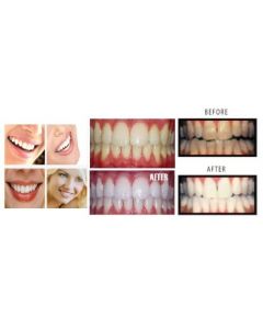 10- X-LARGE 38% Teeth Whitening Gel. Dental Lab Direct